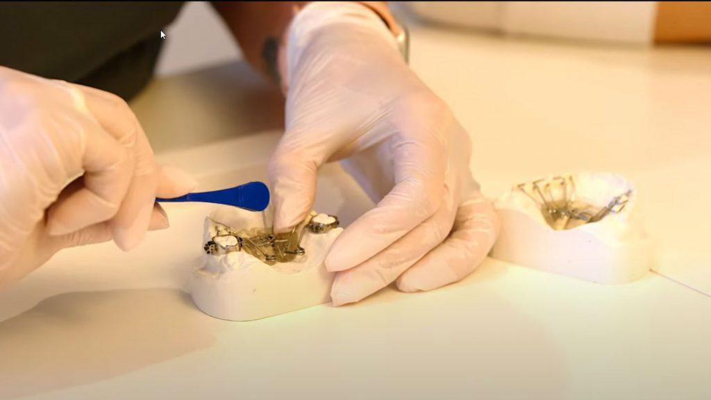 Wie verstelle ich meine Gaumennaterweiterung?