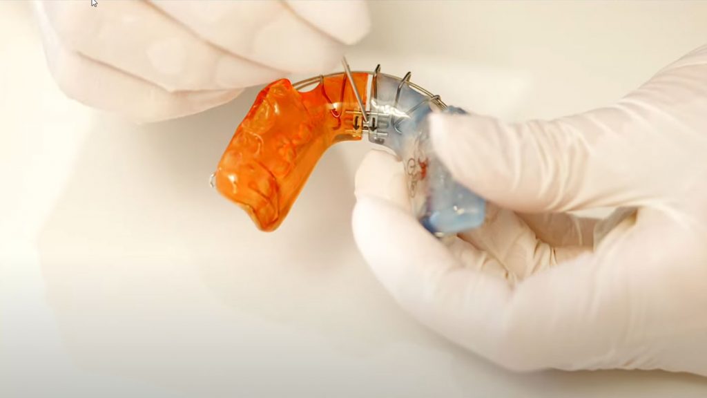 Wie verstelle ich meine herausnehmbare Zahnspange?